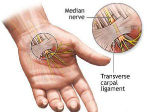 سندرم تونل کارپال ، سندروم تونل کارپال
